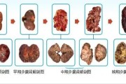 多囊肾的治疗：从根源解决困扰