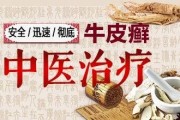 小标题：牛皮癣的中医偏方治疗效果显著