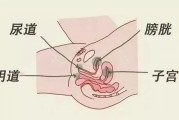 阴道瘘：原因、症状及治疗方法