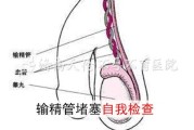 输精管堵塞引起的症状及其处理方法