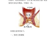 肛裂的治疗方法：逐步缓解疼痛，促进伤口愈合