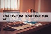 疱疹治疗方法：有效控制和缓解症状的关键