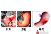 胃穿孔症状：了解、预防和治疗方法