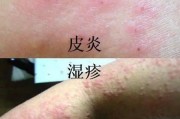 湿疹是什么症状？如何缓解湿疹症状