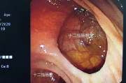 十二指肠憩室：病理、症状与治疗