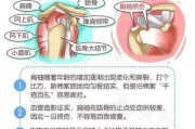 【健身肩部训练】健身肩部受伤怎么办？