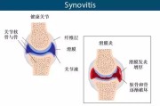 滑膜炎的症状及其表现