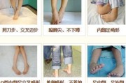 【怎么破剪刀腿】如何判断是否为剪刀腿？