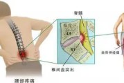 腰椎间盘突出症状分析与治疗措施！