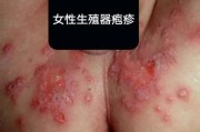 生殖疱疹症状：了解病情及治疗方法