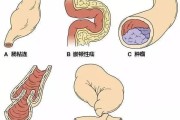 肠梗阻的症状及识别方法