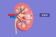 肾囊肿症状：了解肾囊肿症状及其提示的健康问题